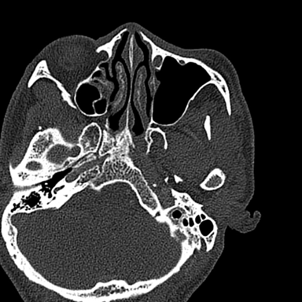 Ameloblastoma (Radiopaedia 51921-57766 Axial bone window 146).jpg