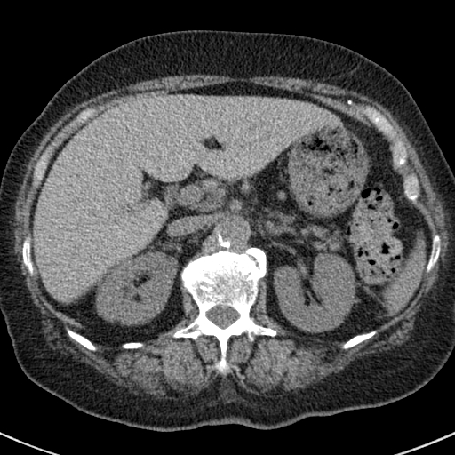 File:Amiodarone-induced pulmonary fibrosis (Radiopaedia 82355-96460 Axial non-contrast 62).jpg