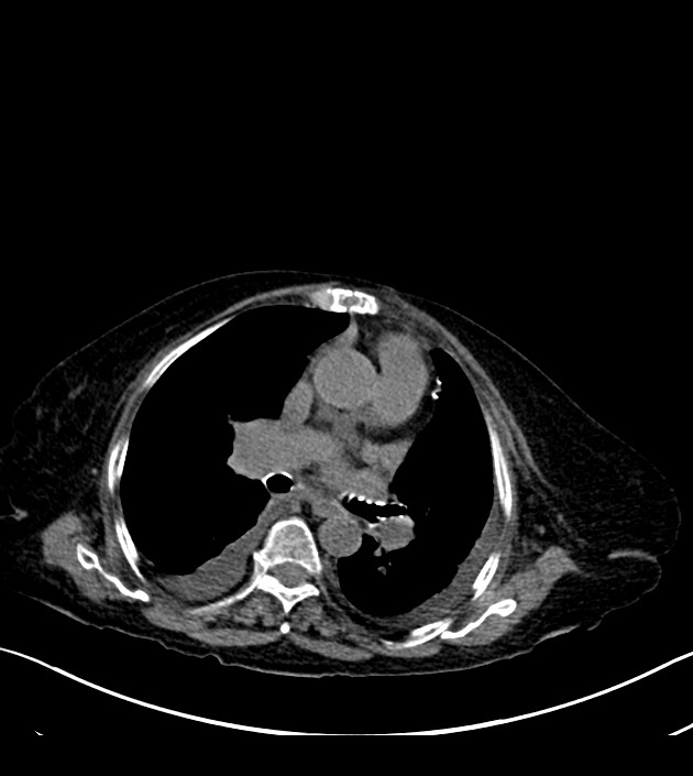 Amiodarone deposition in the liver (Radiopaedia 77587-89780 Axial non-contrast 38).jpg