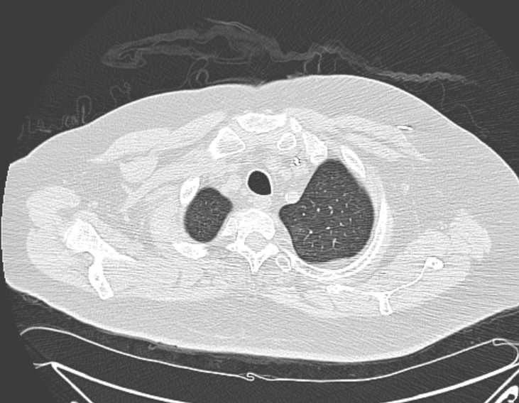 Amiodarone lung (Radiopaedia 62514-70769 Axial lung window 11).jpg
