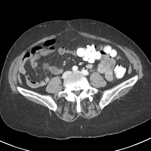 Ampullary adenocarcinoma (Radiopaedia 34013-35237 C 33).png
