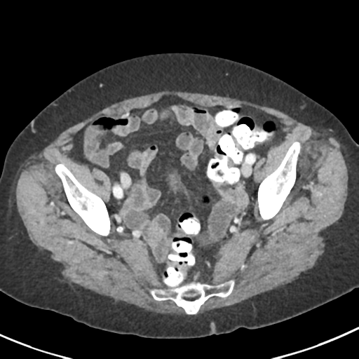Ampullary adenocarcinoma (Radiopaedia 34013-35237 C 46).png