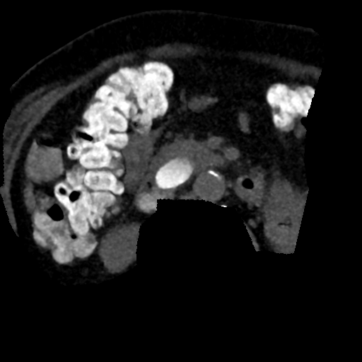Ampullary adenocarcinoma (Radiopaedia 34013-35241 AXIAL MIPS 3-1.5 83).png