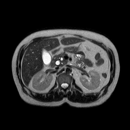 File:Ampullary tumor (Radiopaedia 27294-27479 T2 10).jpg