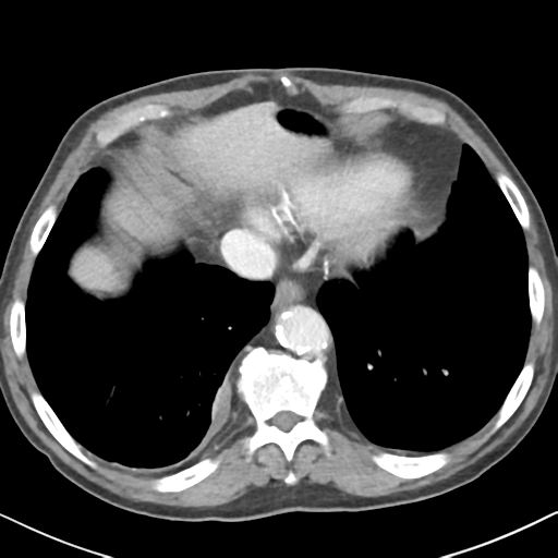 File:Amyand hernia (Radiopaedia 39300-41547 A 4).png