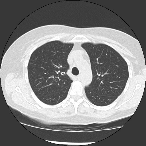 Amyloidosis - bronchial and diffuse nodular pulmonary involvement (Radiopaedia 60156-67744 B 18).jpg