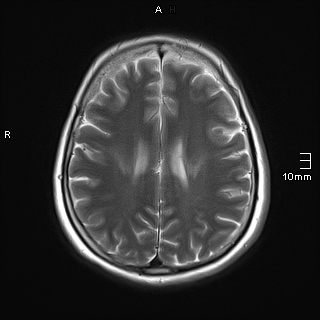 File:Amyotrophic lateral sclerosis (Radiopaedia 70821-81017 Axial T2 17).jpg