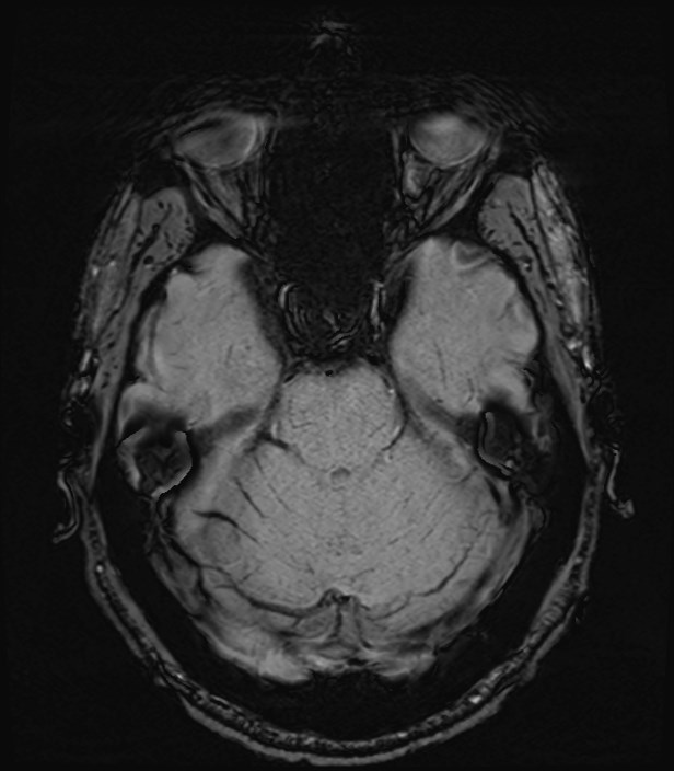 Amyotrophic lateral sclerosis (Radiopaedia 87352-103658 Axial SWI 14).jpg