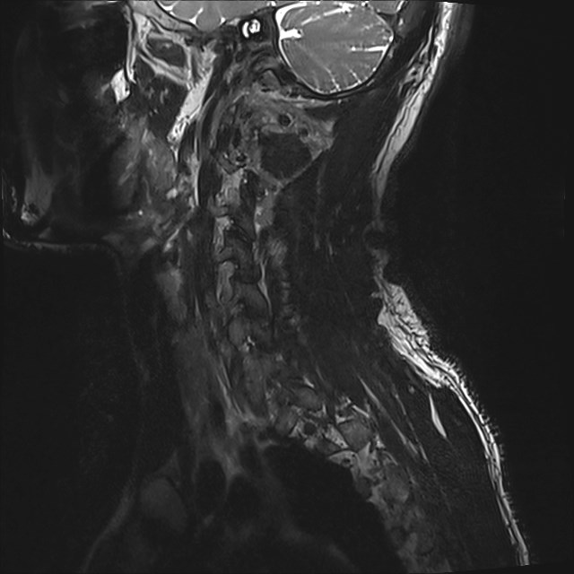 Amyotrophic lateral sclerosis (Radiopaedia 87352-103658 I 62).jpg