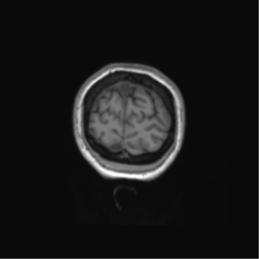 Anaplastic astrocytoma IDH mutant (Radiopaedia 50046-55341 Coronal T1 7).png
