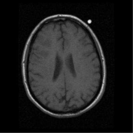 File:Anaplastic meningioma with recurrence (Radiopaedia 34452-35783 Axial T1 14).png