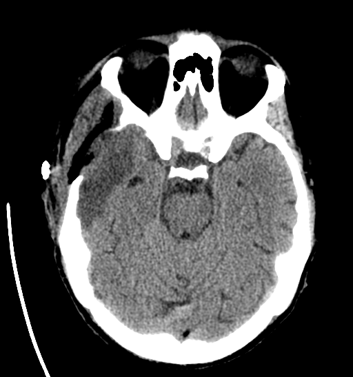 File:Anaplastic meningioma with recurrence (Radiopaedia 34452-35786 Axial non-contrast 12).png