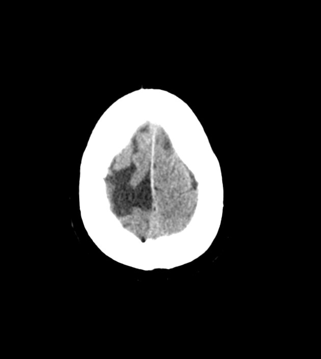 Anaplastic oligodendroglioma (Radiopaedia 79571-92758 Axial non-contrast 45).jpg