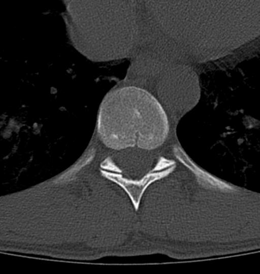 Aneurysmal bone cyst T11 (Radiopaedia 29294-29721 Axial bone window 27).jpg
