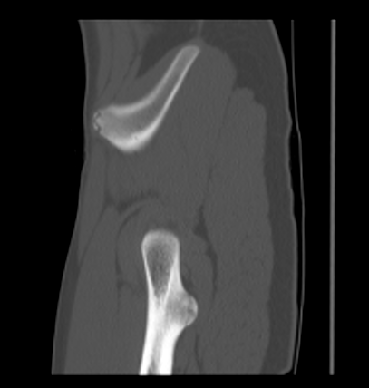 Aneurysmal bone cyst of ischium (Radiopaedia 25957-26094 Sagittal bone window 13).png