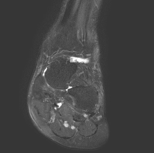File:Aneurysmal bone cyst of the calcaneus (Radiopaedia 60669-68420 Coronal T2 fat sat 3).jpg