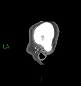 Aneurysmal subarachnoid hemorrhage with intra-axial extension (Radiopaedia 84371-99732 B 67).jpg