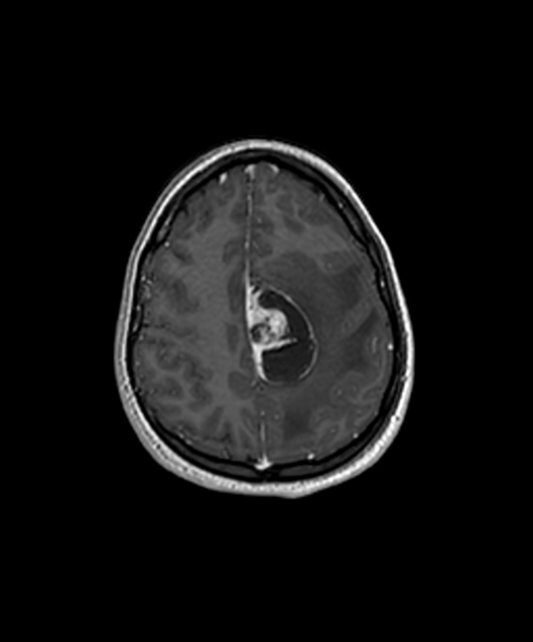 Angiomatous meningioma (Radiopaedia 79459-92577 Axial T1 C+ 3D ISO 38).jpg