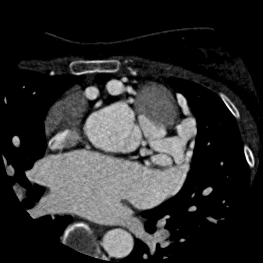 File:Anomalous left coronary artery from the pulmonary artery (ALCAPA) (Radiopaedia 40884-43586 A 20).jpg