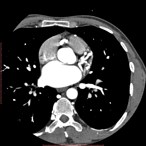 File:Anomalous left coronary artery from the pulmonary artery (ALCAPA) (Radiopaedia 70148-80181 A 124).jpg