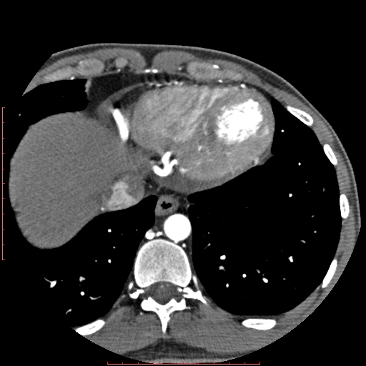 File:Anomalous left coronary artery from the pulmonary artery (ALCAPA) (Radiopaedia 70148-80181 A 333).jpg