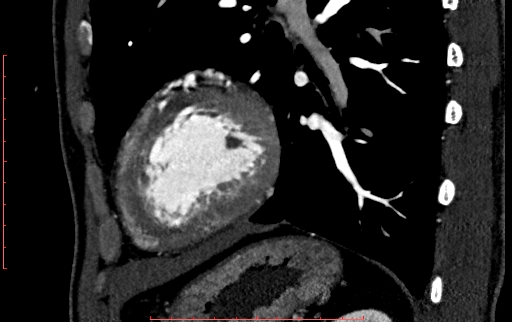 File:Anomalous left coronary artery from the pulmonary artery (ALCAPA) (Radiopaedia 70148-80181 C 198).jpg