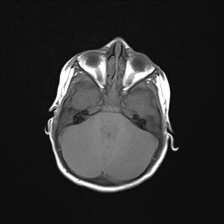 File:Anoxic brain injury (Radiopaedia 79165-92139 Axial T1 8).jpg