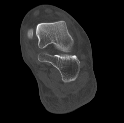 Anterior calcaneal process fracture (Radiopaedia 47384-51989 Coronal bone window 59).png