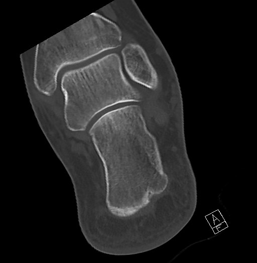 Anterior calcaneal process fracture (Radiopaedia 63353-71943 Axial bone window 108).jpg
