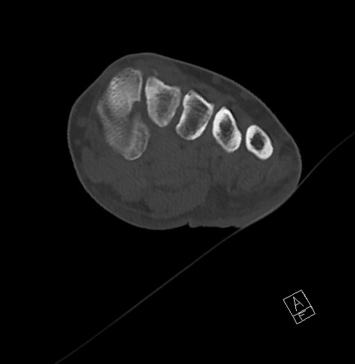 Anterior calcaneal process fracture (Radiopaedia 63353-71943 Axial bone window 70).jpg