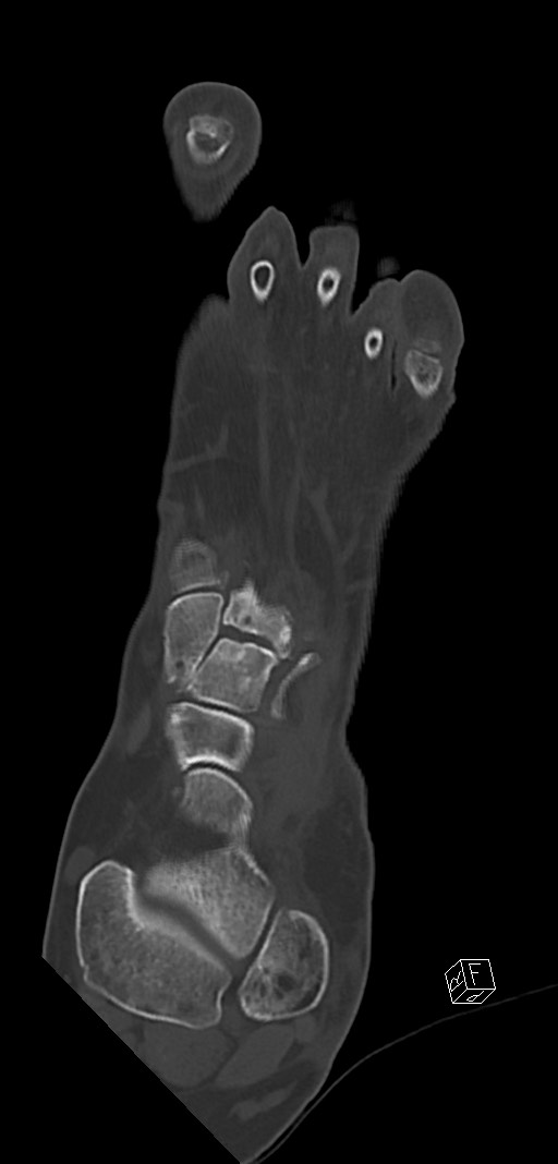 Anterior calcaneal process fracture (Radiopaedia 63353-71943 Coronal bone window 16).jpg
