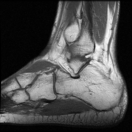 File:Anterior calcaneal process fracture (Radiopaedia 74654-85611 Sagittal T1 16).jpg