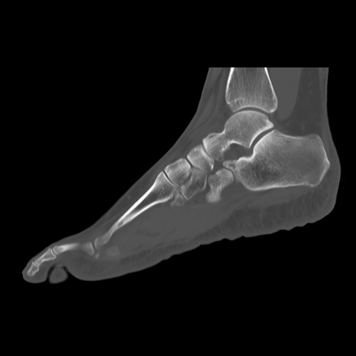 File:Anterior calcaneal process fracture (Radiopaedia 82590-96762 Sagittal bone window 15).jpg