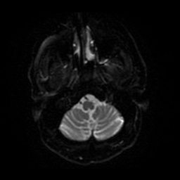 Anterior cerebral artery infarction (Radiopaedia 46794-51323 Axial DWI 32).jpg