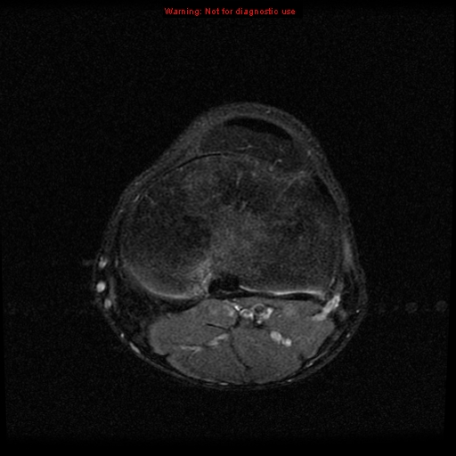 File:Anterior cruciate ligament injury - partial thickness tear (Radiopaedia 12176-12515 Axial PD 18).jpg