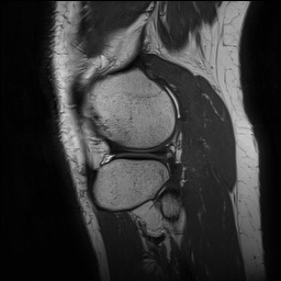 Anterior cruciate ligament rupture and posteromedial corner injury (Radiopaedia 67338-76723 Sagittal PD 133).jpg