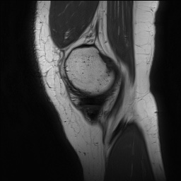 Anterior cruciate ligament rupture and posteromedial corner injury (Radiopaedia 67338-76723 Sagittal PD 32).jpg