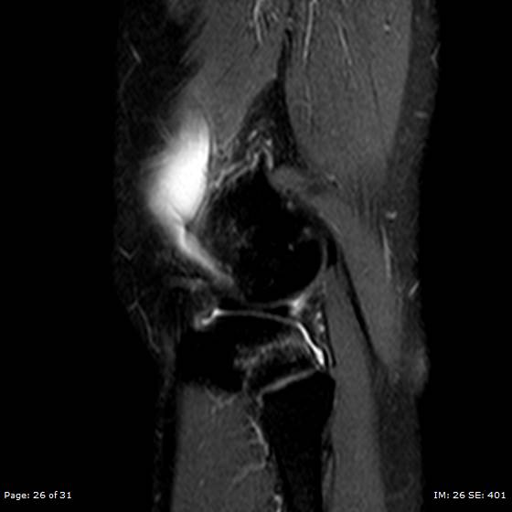 File:Anterior cruciate ligament tear (Radiopaedia 70783-80964 Sagittal STIR 26).jpg