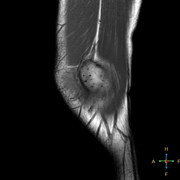 File:Anterior cruciate ligament tear - complete (Radiopaedia 24907-25170 Sagittal T1 18).jpg