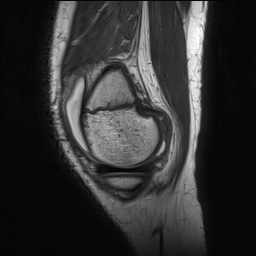 Anterior cruciate ligament tear - pediatric (Radiopaedia 62152-70260 Sagittal PD 37).jpg
