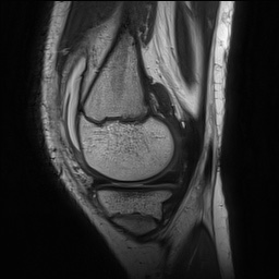 Anterior cruciate ligament tear - pediatric (Radiopaedia 62152-70260 Sagittal PD 50).jpg