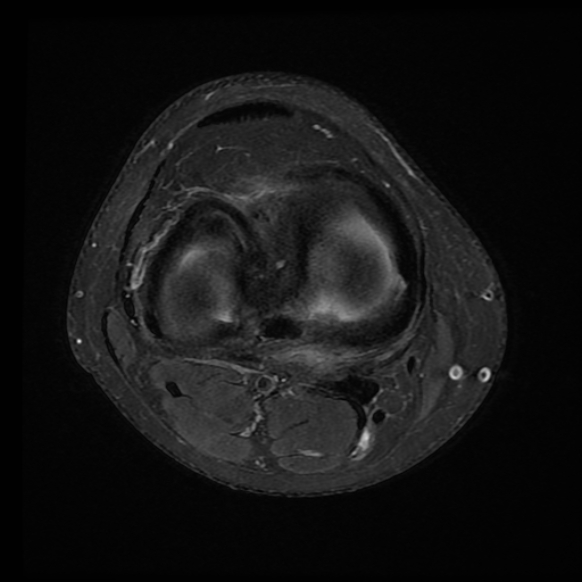 File:Anterior cruciate ligament tear with posteromedial corner injury, bucket-handle meniscal tear and chondral delamination (Radiopaedia 75501-86744 Axial PD fat sat 9).jpg