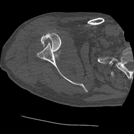 Anterior glenohumeral dislocation with Hill-Sachs lesion (Radiopaedia 62877-71249 Axial bone window 35).jpg