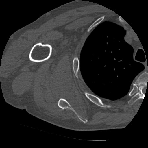 File:Anterior glenohumeral dislocation with Hill-Sachs lesion (Radiopaedia 62877-71249 Axial bone window 60).jpg