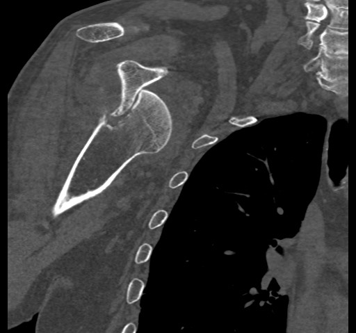 Anterior glenohumeral dislocation with Hill-Sachs lesion (Radiopaedia 62877-71249 Coronal bone window 47).jpg