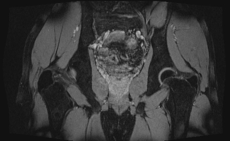 Anterior inferior iliac spine avulsion fracture (Radiopaedia 81312-95000 G 21).jpg