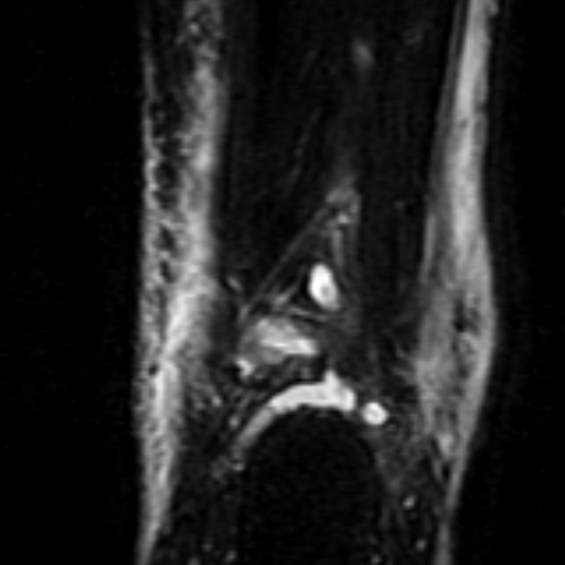 File:Anterior talofibular ligament rupture (Radiopaedia 15831-15484 Coronal STIR 19).jpg