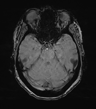Anterior temporal pole cysts (Radiopaedia 46629-51102 Axial SWI 31).png
