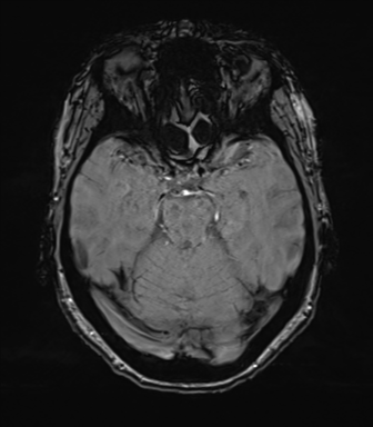 Anterior temporal pole cysts (Radiopaedia 46629-51102 Axial SWI 33).png