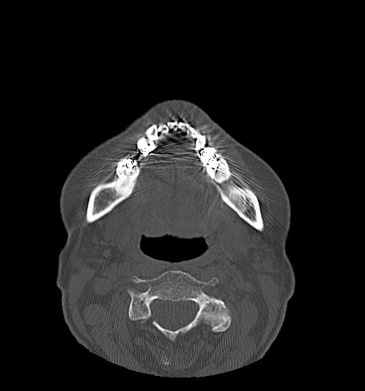 Anterior temporomandibular joint dislocation (Radiopaedia 59430-66784 Axial non-contrast 45).jpg